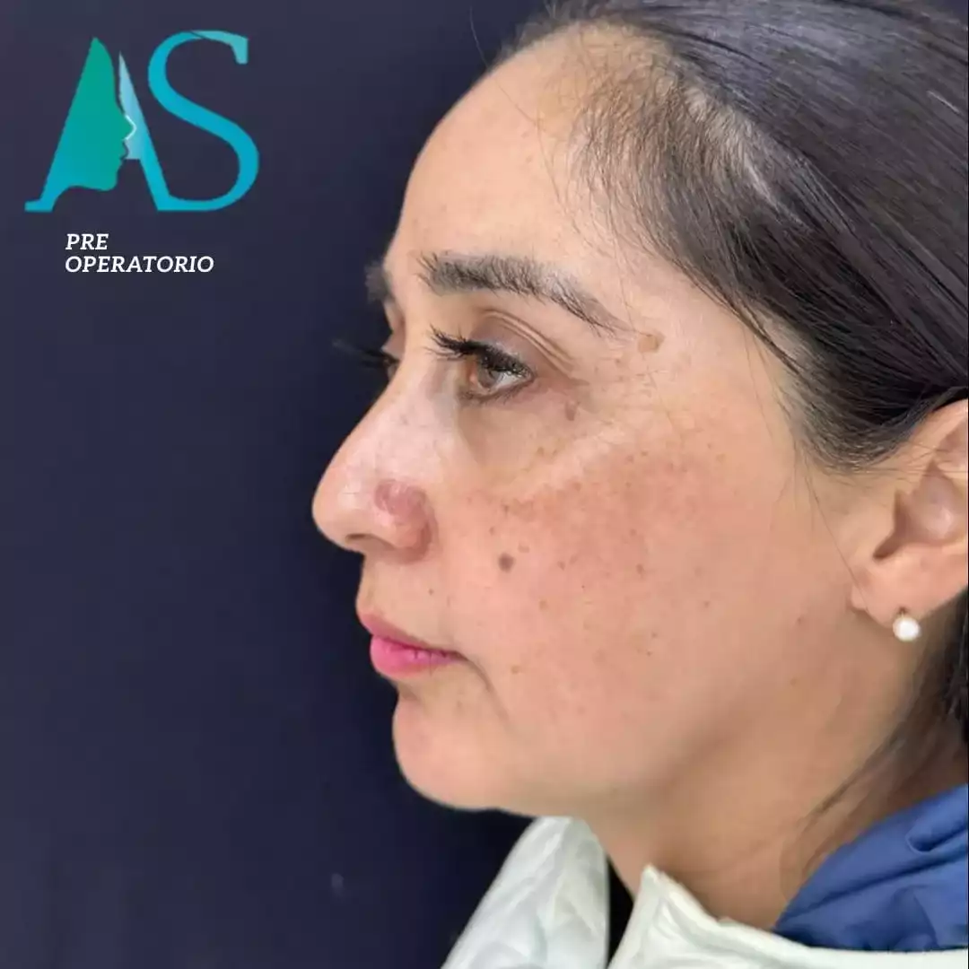 Rinoplastia Ultrasónica