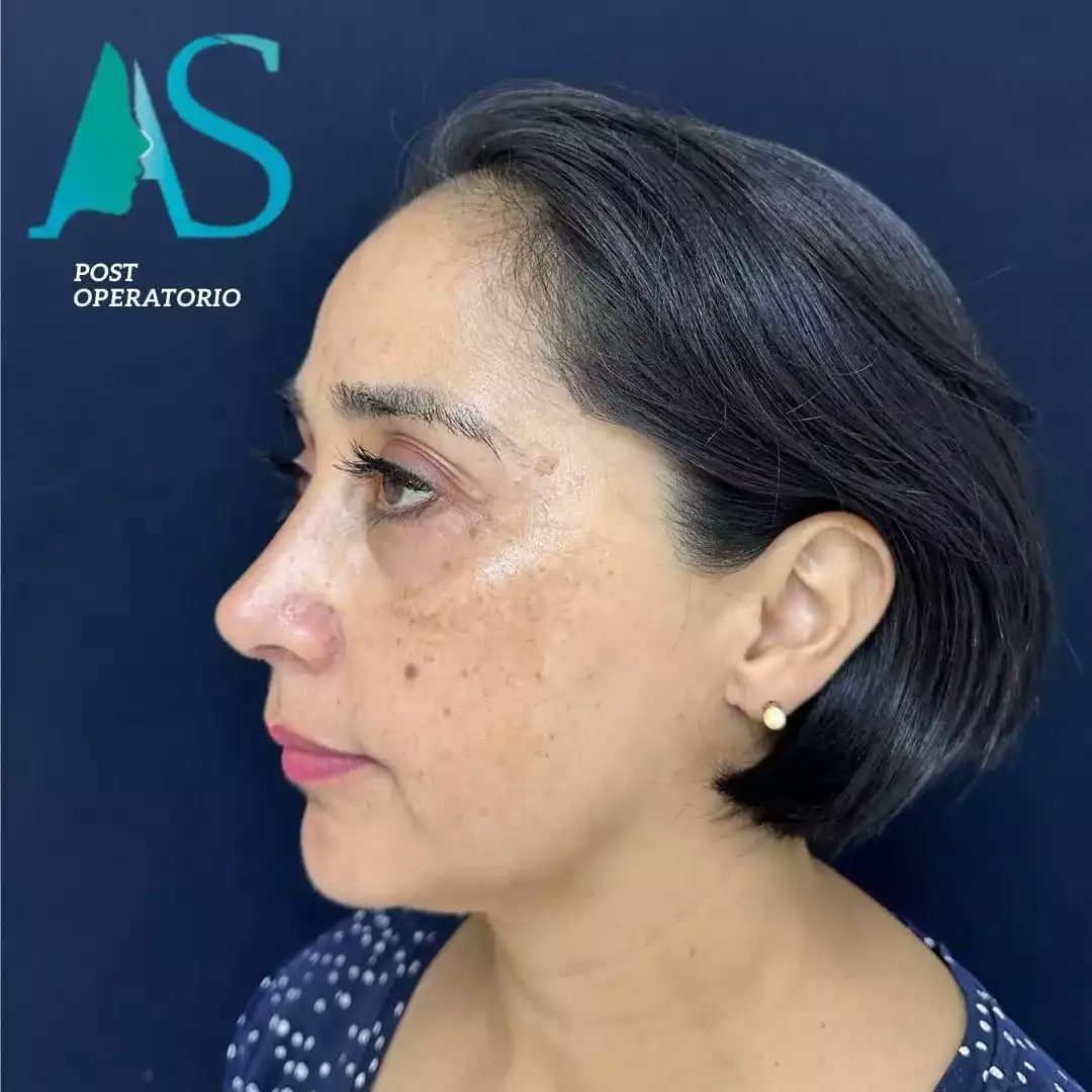 Rinoplastia Ultrasónica