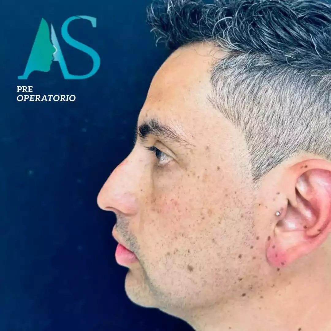 Rinoplastia Ultrasónica