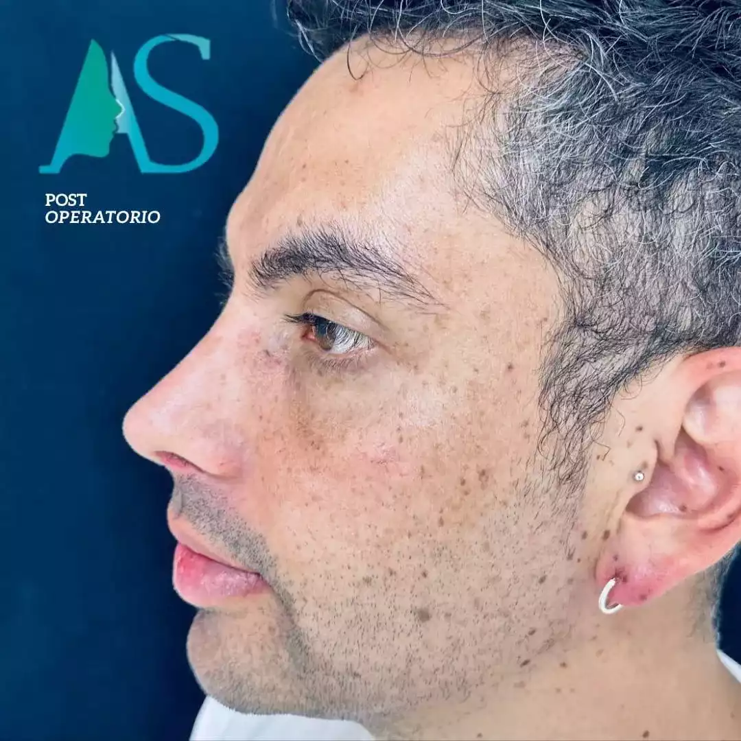 Rinoplastia Ultrasónica