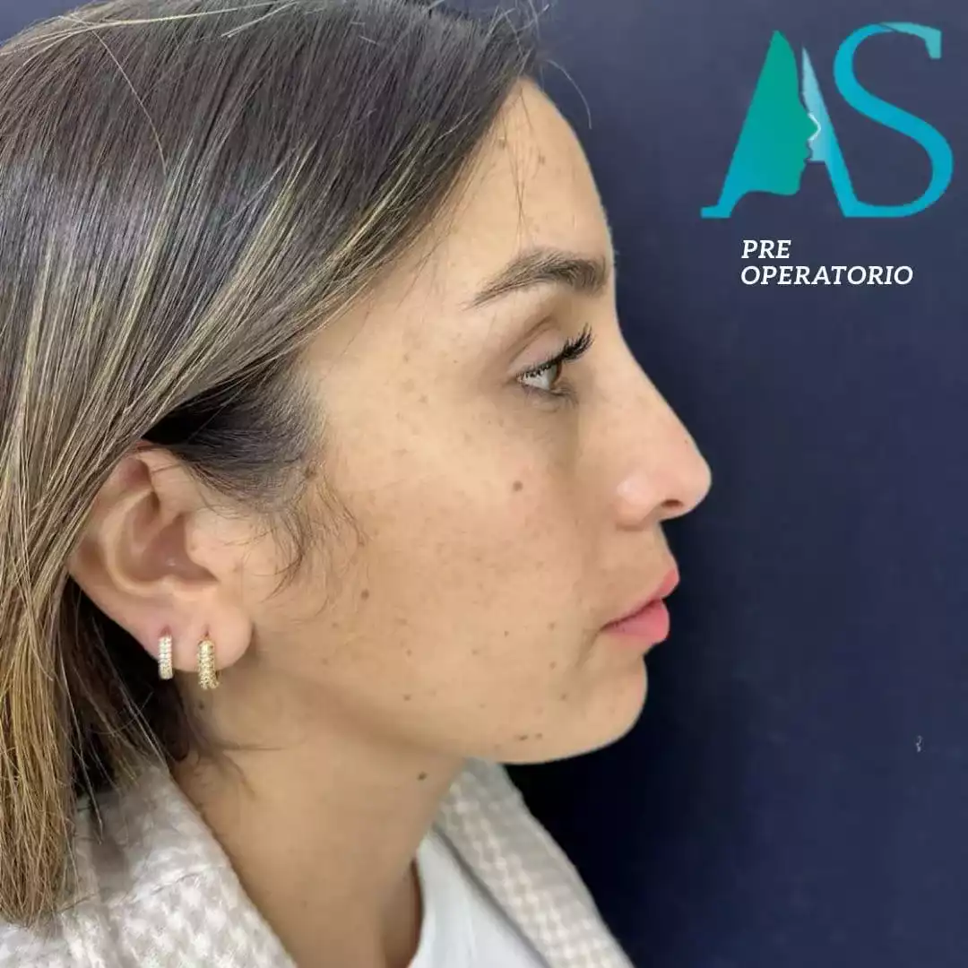 Rinoplastia Ultrasónica