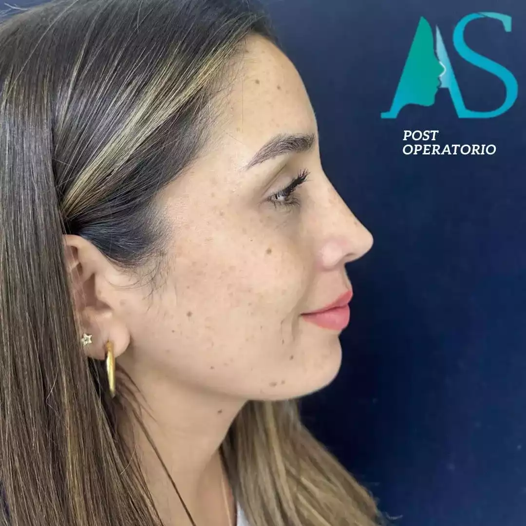 Rinoplastia Ultrasónica