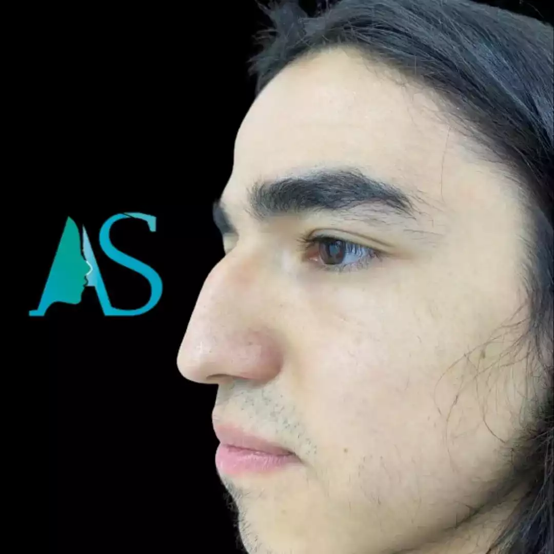 Rinoplastia Ultrasónica