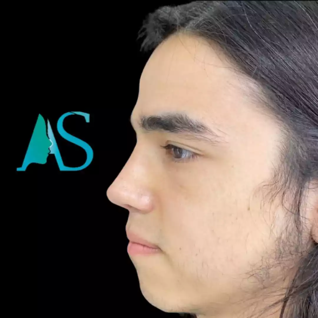 Rinoplastia Ultrasónica