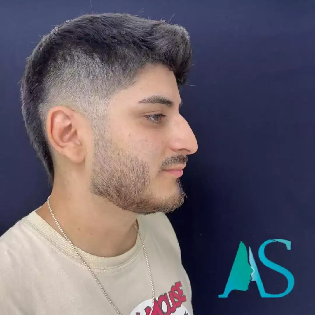 Rinoplastia Ultrasónica