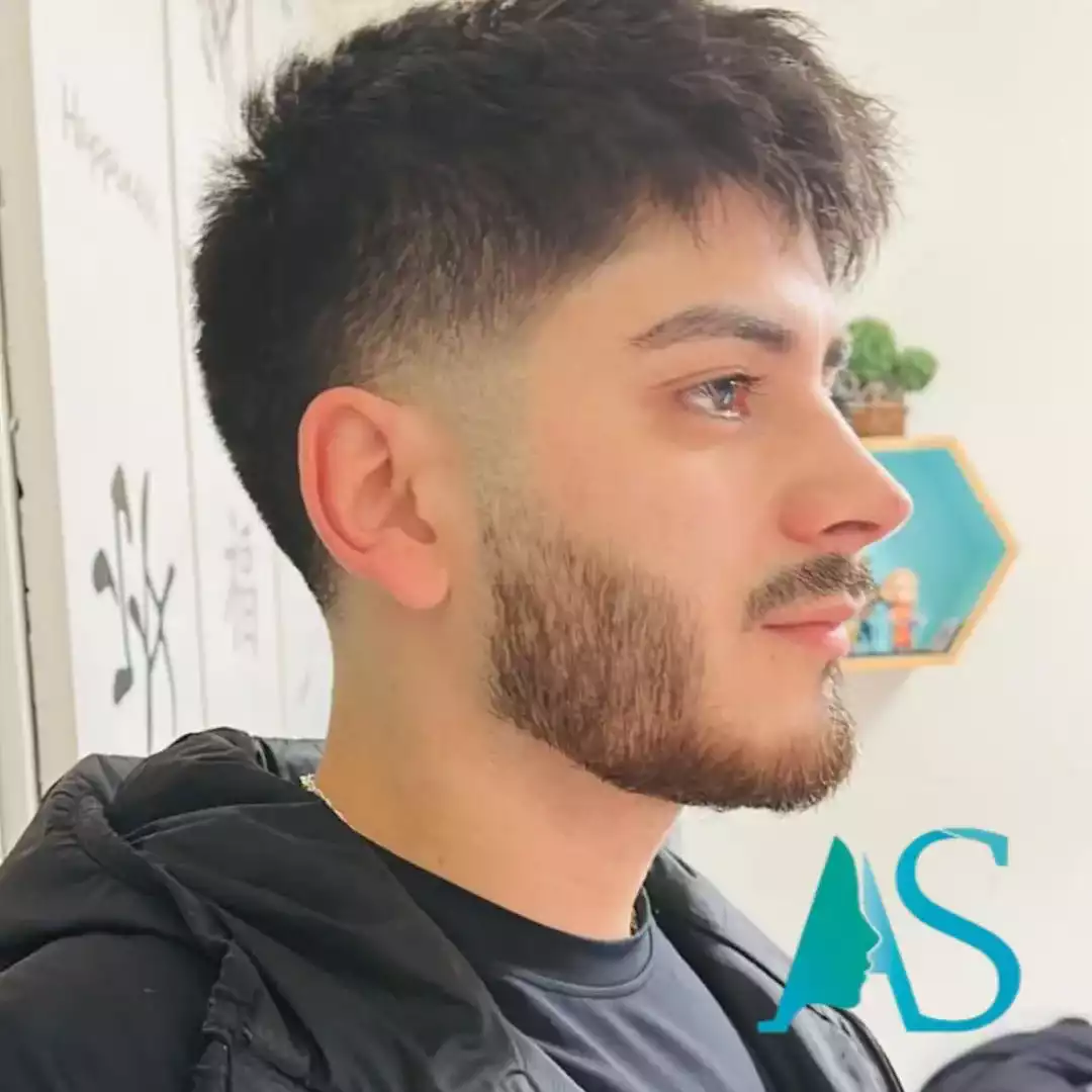 Rinoplastia Ultrasónica