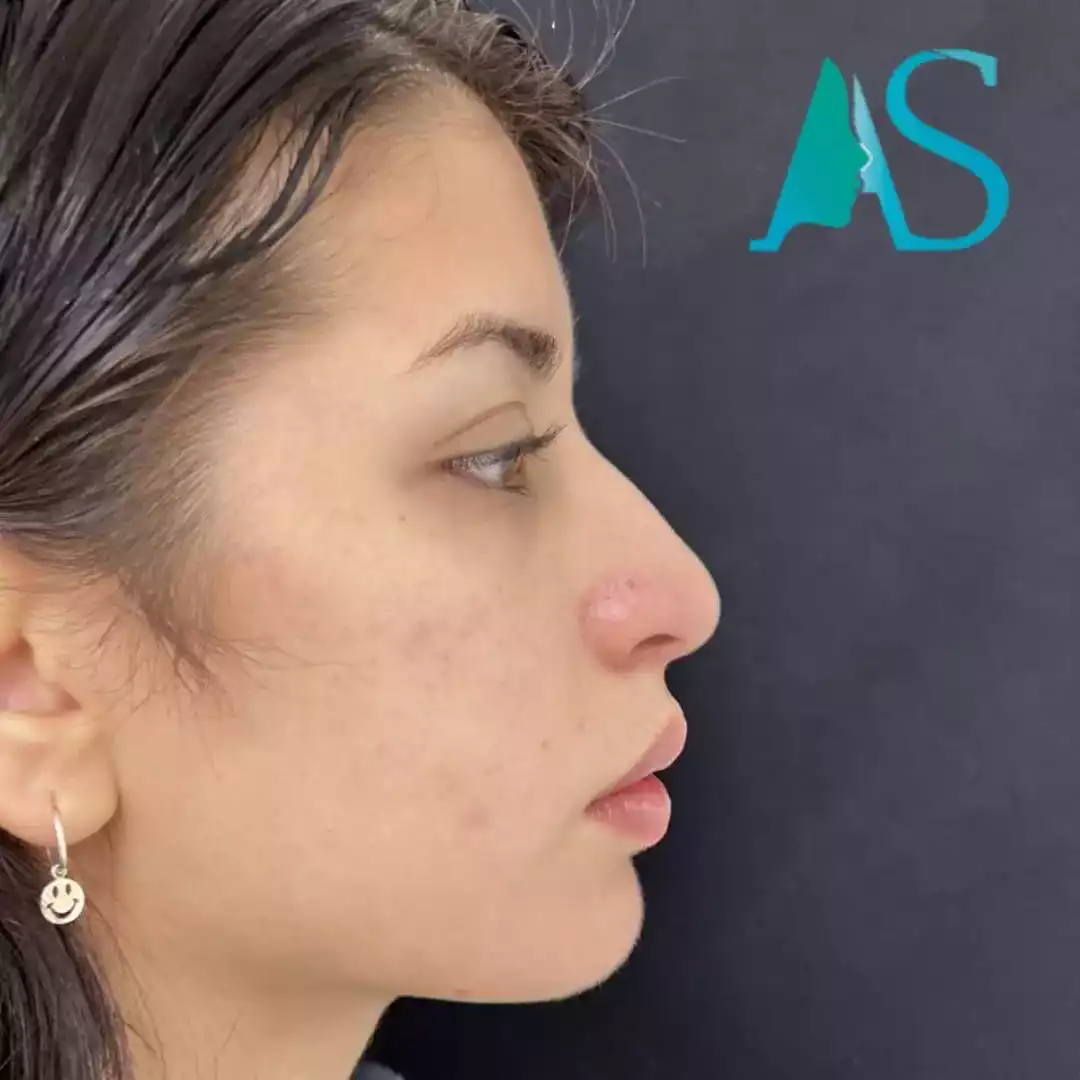 Rinoplastia Ultrasónica