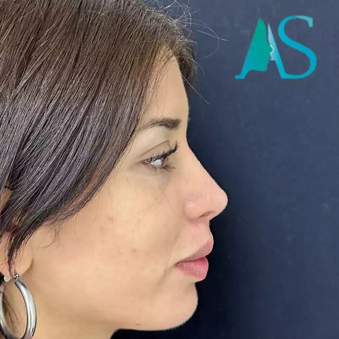 Rinoplastia Ultrasónica